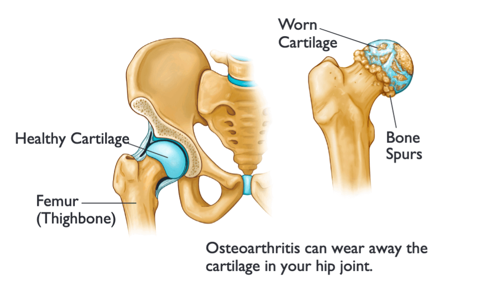 Total Hip Replacement or Arthroplasty